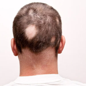 Diagnosis and Treatment of Alopecia Areata