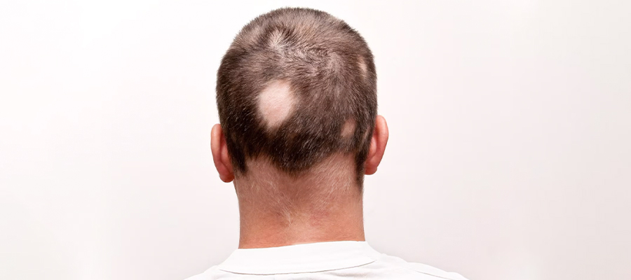 Diagnosis and Treatment of Alopecia Areata