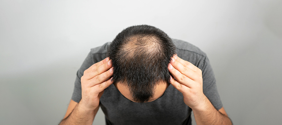 Diagnosis and Treatment of Androgenetic Alopecia