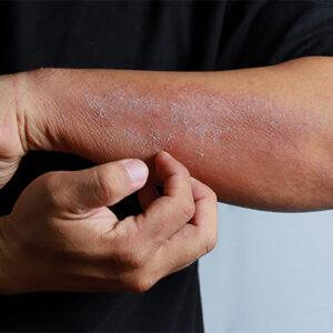 Diagnosis and Treatment of Eczema Diseases