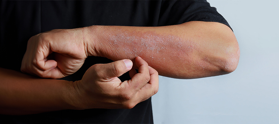 Diagnosis and Treatment of Eczema Diseases