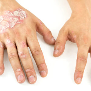 Diagnosis and Treatment of Psoriasis