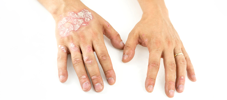 Diagnosis and Treatment of Psoriasis