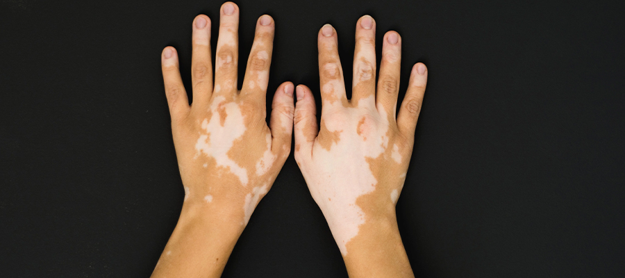 Diagnosis and Treatment of Vitiligo