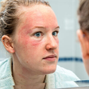 Rosacea Diagnosis and Treatment