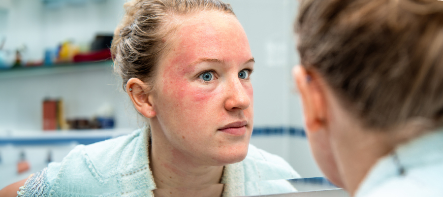 Rosacea Diagnosis and Treatment