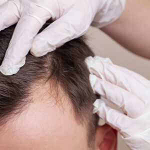 Diagnostic et Traitement des Maladies des Cheveux et du Cuir Chevelu