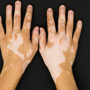 Diagnostic et Traitement du Vitiligo